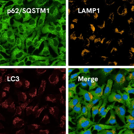 Hydroxychloroquine-treated HeLa cells stained with the PhenoVue autophagy staining kit.